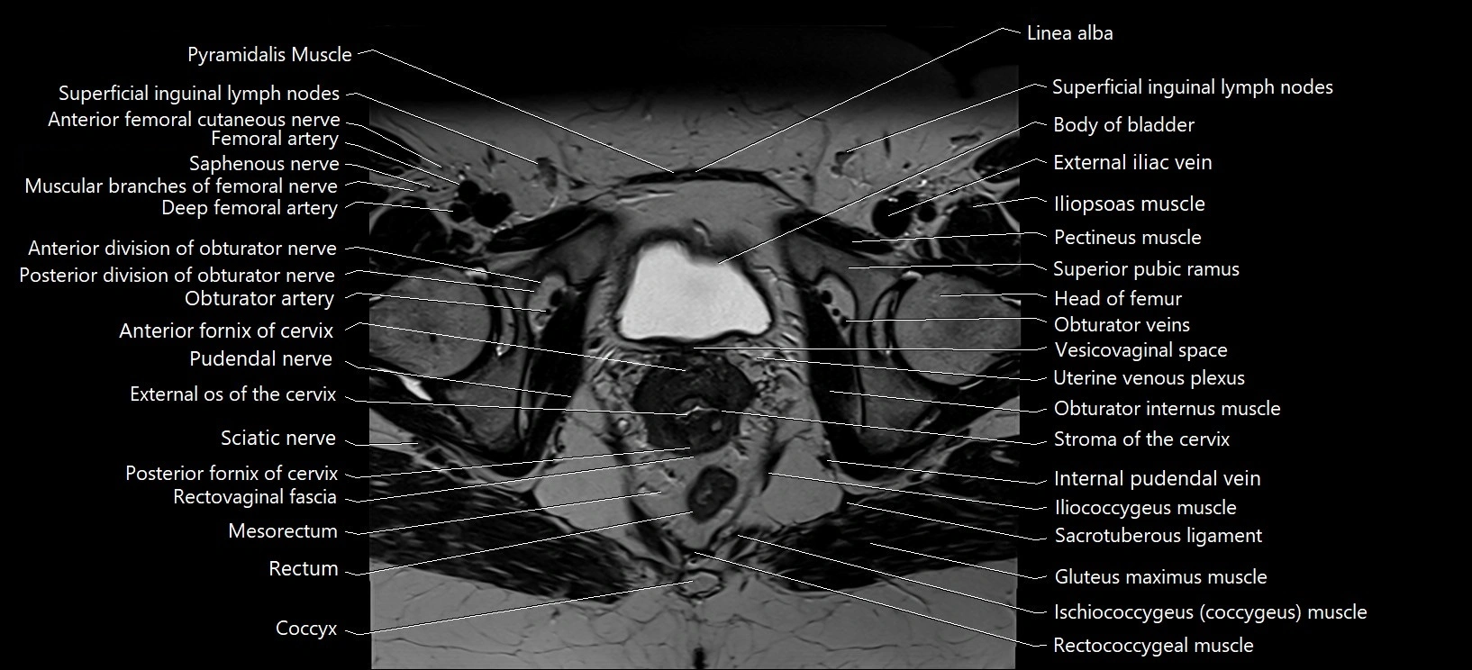 Axial cross sectional anatomy of female pelvis (MRI 3T) image 30.webp